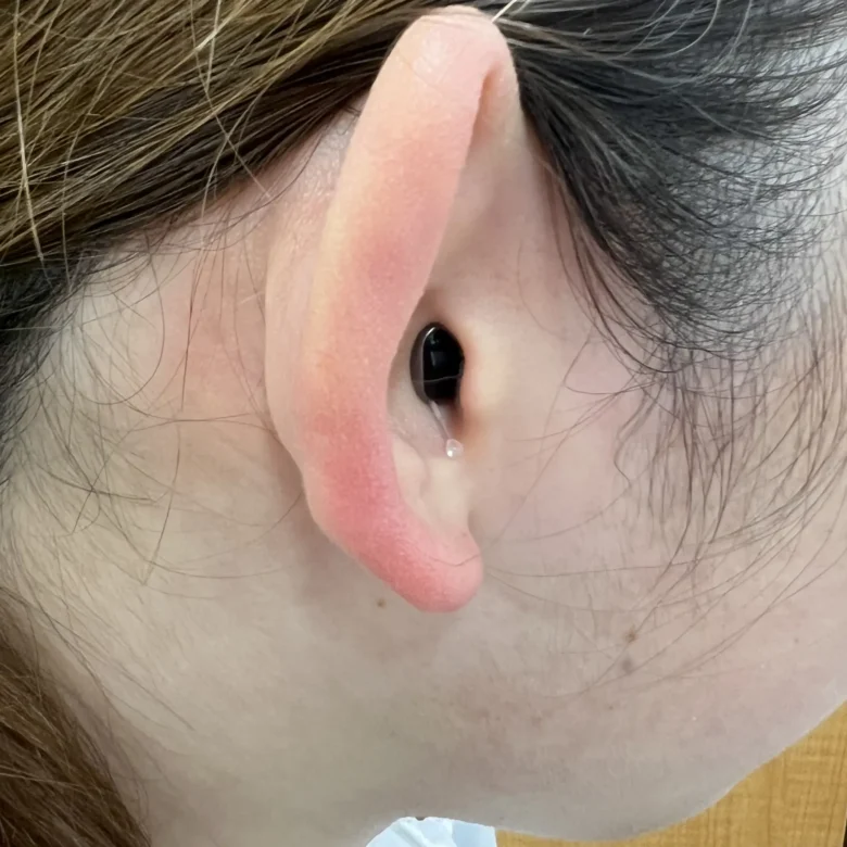 耳あな型補聴器 フォナック バートI チタン 【Phonak Virto I-titan】装用